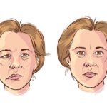 bells-palsy_270115841.jpg